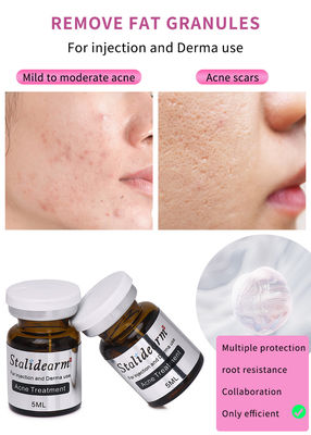 Pabrik Pasokan Pembersih Kulit jerawat Perbaikan Pengobatan jerawat Penghapusan Komedo Mesoterapi Serum Injeksi OEM/ODM