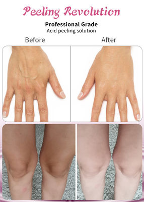 Professional Grade Acid Peeling Solution Set Cairan untuk Pengelupasan Wajah