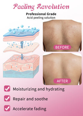 Serum Pengelupasan Kulit Berkualitas Profesional Set Produk Perawatan Kulit Pembersihan Perbaikan Kulit Revitalisasi Solusi Pengelupasan